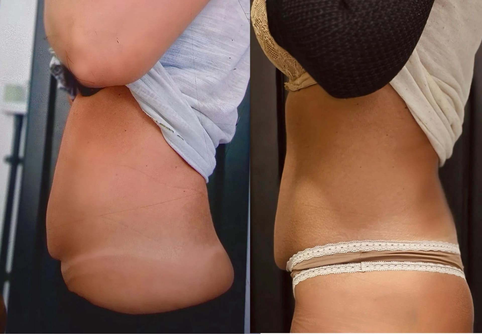 EMS Sculpting stomach before and after